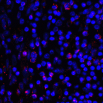 Immunofluorescence of PD-L1 in human stomach carcinoma tissue with PD-L1 antibody at 2 μg/mL. <br><br>Red: PDL1 Antibody [1D7] (RF16038) <br> Blue: DAPI staining