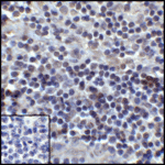<strong>Figure 9 Immunohistochemistry Validation of PD-L1 in Human Tonsil Carcinoma Tissue </strong><br>Immunohistochemical analysis of paraffin-embedded human tonsil tissue using anti-PD-L1 antibody (RF16035) at 5 μg/ml. Tissue was fixed with formaldehyde and blocked with 10% serum for 1 h at RT; antigen retrieval was by heat mediation with a citrate buffer (pH6). Samples were incubated with primary antibody overnight at 4°C. A goat anti-mouse IgG H&L (HRP) at 1/250 was used as secondary. Counter stained with Hematoxylin. Lower left: Use mouse IgG antibody at 1 μg/ml as control.