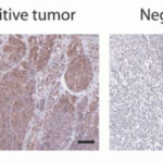 <strong>Figure 12 Immunohistochemistry Validation of PD-L1 in Human Tumors (Gadiot et al., 2011) </strong><br>Immunohistochemical analysis of patient tumors labeling PD-L1 with anti-PD-L1 antibodies (4059). Several anti-PD-L1 antibodies were tested for staining, <strong> “Only 1 antibody gave no background staining and was competitively blocked by the addition of PD-L1Fc protein (ProSci, #4059)”. <strong>
