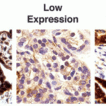 <strong>Figure 13 Immunohistochemistry Validation of PD-L1 in Human thyroid cancer (Angell et al., 2014) </strong><br>Immunohistochemical analysis of PD-L1 expression in human thyroid cancer with anti-PD-L1 antibodeis (4059). Placenta was used a positive control.
