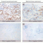 <strong>Figure 14 Immunohistochemistry Validation of PD-L1 in Human Lung Cancer (Ilie et al., 2015) </strong><br>Surgical specimens (left panel) and matched biopsy specimens (right panel). PD-L1-positive (A,B) and PD-L1-negative (C,D) tumors.