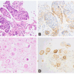 <strong>Figure 15 Immunohistochemistry Validation of PD-L1 in Human Lung adenocarcinoma (Heymann et al., 2017) </strong><br> HE staining (left panel) and PD-L1 expression (right panel) in the tumor and pleural fluid for a patient with lung adenocarcinoma. PD-L1 expression detected by anti-PD-L1 antibodies (4059) demonstrated membranous staining in approximately 80% of tumor cells (C) and in approximately 75% of tumor cells (D), respectively.