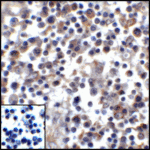 Immunohistochemistry of PD-L1 in human stomach carcinoma tissue with PD-L1 antibody at 5 μg/mL.