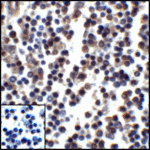 Immunohistochemistry of PD-L1 in human stomach carcinoma tissue with PD-L1 antibody at 5 μg/mL.