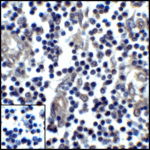 <strong>Figure 8 Immunohistochemistry Validation of PD-L1 in Human Stomach Carcinoma Tissue </strong><br>Immunohistochemical analysis of paraffin-embedded human stomach carcinoma tissue using anti-PD-L1 antibody (RF16035) at 5 μg/ml. Tissue was fixed with formaldehyde and blocked with 10% serum for 1 h at RT; antigen retrieval was by heat mediation with a citrate buffer (pH6). Samples were incubated with primary antibody overnight at 4°C. A goat anti-mouse IgG H&L (HRP) at 1/250 was used as secondary. Counter stained with Hematoxylin. Lower left: Use mouse IgG antibody at 1 μg/ml as control.