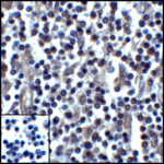 Immunohistochemistry of PD-L1 in human stomach carcinoma tissue with PD-L1 antibody at 5 μg/mL.
