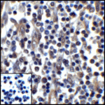 Immunohistochemistry of PD-L1 in human stomach carcinoma tissue with PD-L1 antibody at 5 μg/mL.
