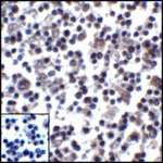 Immunohistochemistry of PD-L1 in human stomach carcinoma tissue with PD-L1 antibody at 5 μg/mL.