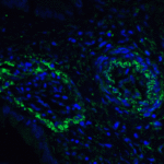 Immunofluorescence of PD-L2 in human colon carcinoma tissue with PD-L2 antibody at 20 μg/mL. <br><br>Green: PDL2 Antibody [4E10] (RF16021) <br> Blue: DAPI staining
