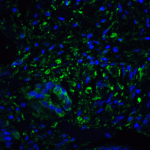 Immunofluorescence of PD-L2 in human colon carcinoma tissue with PD-L2 antibody at 20 μg/mL. <br><br>Green: PDL2 Antibody [8C12] (RF16022) <br> Blue: DAPI staining