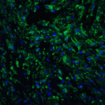 Immunofluorescence of PD-L2 in human colon carcinoma tissue with PD-L2 antibody at 20 μg/mL. <br><br>Green: PDL2 Antibody [7C7] (RF16023) <br> Blue: DAPI staining