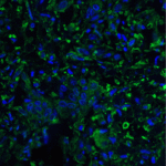 Immunofluorescence of PD-L2 in human colon carcinoma tissue with PD-L2 antibody at 20 μg/mL. <br><br>Green: PDL2 Antibody [10H6] (RF16025) <br> Blue: DAPI staining