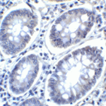 Immunohistochemistry of PD-L2 in human colon carcinoma tissue with PD-L2 antibody at 2 μg/mL.