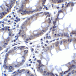 Immunohistochemistry of PD-L2 in human colon carcinoma tissue with PD-L2 antibody at 2 μg/mL.