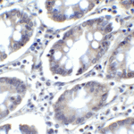 Immunohistochemistry of PD-L2 in human colon carcinoma tissue with PD-L2 antibody at 2 μg/mL.