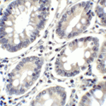 Immunohistochemistry of PD-L2 in human colon carcinoma tissue with PD-L2 antibody at 2 μg/mL.