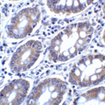 Immunohistochemistry of PD-L2 in human colon carcinoma tissue with PD-L2 antibody at 2 μg/mL.
