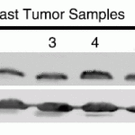 <strong>Figure 7  Increased Expression Validation of PHAPI in Patient Samples of BreastTumor Tissue (Schafer et al., 2006) </strong><br> PHAPI was overexpressed in all breast tumor samples of patients and human breast cancer cells (MDA-MB-453), but not in the normal breast tissue or human primary mammary epithelial cells (HMEC).