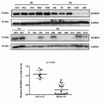 <strong>Figure 7 Overexpression  of SAMHD1 in CD4+ T-cells from Healthy Donors and Sézary Syndrome (SS) patients(Kohnken et al.,  2017)</strong><br>SAMHD1 protein expression detected by anti-SAMHD1 antibodies (8007) was significantly reduced in CD+ T-cells from 15 SS patients as compared to those from 7 healthy donors.