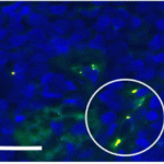 <strong>Figure 4  IF Validation of Envelope in COVID-19 Patient Skin  </strong><br>  (Magro et al., 2020)Detection of SARS-CoV-2 Envelope protein in the skin of COVID-19 patients that were confirmed by PCR. The skin staining shows Envelope protein expression (green) <strong>detected by envelope antibodies (3531, 3 μg/mL) </strong> in mononuclear cells with hematoxylin counterstain. The staining was negative in control normal skin/lung (not shown).