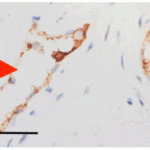 <strong>Figure 5  IHC  Validation of Envelope in COVID-19 Patient Skin  </strong><br>  (Magro et al., 2020)Detection of SARS-CoV-2 Envelope protein in the blood vessels of COVID-19 patients that were confirmed by PCR. The staining shows Envelope protein expression (green) <strong>detected by envelope antibodies (3531, 3 μg/mL) </strong> in the endothelial cytoplasms in thrombosed and normal appearing blood vessels with hematoxylin counterstain. The staining was negative in control normal skin/lung (not shown).