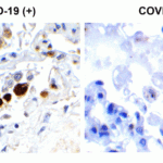 <strong>Figure 1 Immunohistochemistry Validation of SARS-CoV-2 (COVID-19) Membrane in COVID-19 Patient Lung</strong><br> Immunohistochemical analysis of paraffin-embedded COVID-19 patient lung tissue using anti- SARS-CoV-2 (COVID-19) Membrane antibody (9157, 0.5 μg/mL). Tissue was fixed with formaldehyde and blocked with 10% serum for 1 h at RT; antigen retrieval was by heat mediation with a citrate buffer (pH6). Samples were incubated with primary antibody overnight at 4°C. A goat anti-rabbit IgG H&L (HRP) at 1/250 was used as secondary. Counter stained with Hematoxylin. Strong signal of SARS-COV-2 Membrane protein was observed in macrophage of COVID-19 patient lung, but not in non-COVID-19 patient lung.