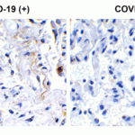 <strong>Figure 1 Immunohistochemistry Validation of SARS-CoV-2 (COVID-19) NSP2 in COVID-19 Patient Lung</strong><br> Immunohistochemical analysis of paraffin-embedded COVID-19 patient lung tissue using anti- SARS-CoV-2 (COVID-19) NSP2 antibody (9173, 0.5 μg/mL). Tissue was fixed with formaldehyde and blocked with 10% serum for 1 h at RT; antigen retrieval was by heat mediation with a citrate buffer (pH6). Samples were incubated with primary antibody overnight at 4°C. A goat anti-rabbit IgG H&L (HRP) at 1/250 was used as secondary. Counter stained with Hematoxylin. Strong signal of SARS-COV-2 NSP2 protein was observed in macrophage of COVID-19 patient lung, but not in non-COVID-19 patient lung.