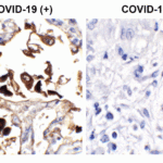 <strong>Figure 1 Immunohistochemistry Validation of SARS-CoV-2 (COVID-19) Nucleocapsid  in COVID-19 Patient Lung</strong><br> Immunohistochemical analysis of paraffin-embedded COVID-19 patient lung tissue using anti- SARS-CoV-2 (COVID-19) Nucleocapsid  antibody (10-352, 1 ug/mL). Tissue was fixed with formaldehyde and blocked with 10% serum for 1 h at RT; antigen retrieval was by heat mediation with a citrate buffer (pH6). Samples were incubated with primary antibody overnight at 4°C. A goat anti-rabbit IgG H&L (HRP) at 1/250 was used as secondary. Counter stained with Hematoxylin. Strong signal of SARS-COV-2 Nucleocapsid protein was observed in the macrophages of COVID-19 patient lung, but not in non-COVID-19 patient lung.