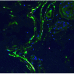 <strong>Figure 8 IF Validation of SARS-CoV2 Spike in COVID-19 Patient Skin</strong><br> (Magro et al., 2020) C4d is highlighted green while COVID-19 spike protein detected by anti-spike antibodies (3525, 0.2 μg/mL) shows a red staining pattern; a yellow signal is discernible indicative of co-localization of C4d and viral protein within the microvasculature.