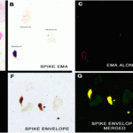 <strong>Figure 6 IHC/IF Validation in COVID-19 Patient Sample </strong><br> (Nuovo et al., 2020)Detection of SARS-CoV-2 proteins in nasopharyngeal swab cell preparations. B. An intense signal for covid-19 spike protein <strong> tested by SARS-CoV-2 spike antibodies (3525) </strong> was observed in the glandular cells. F-H. Co-expression of spike detected by spike antibodies (3525, 0.2 μg/mL) and envelope proteins detected by envelope antibodies (3531, 2 μg/mL) of SARS-CoV-2 (F) documented localization of each protein to glandular cells (G, yellow). No signal was seen in oral swabs of positive cases (H). <strong>Both the spike and envelope protein detected by anti-spike antibodies (3525) and anti-envelope antibodies (3531) produced a signal in the nasopharyngeal swabs of the three cases and no signal was evident in the nasopharyngeal swabs of the seven controls. </strong>