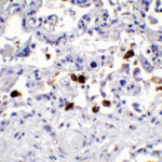 <strong>Figure 5 Immunohistochemistry Validation of SARS-CoV-2 (COVID-19) Spike in COVID-19 Patient Lung</strong><br> Immunohistochemical analysis of paraffin-embedded COVID-19 patient lung tissue using anti-SARS-CoV-2 (COVID-19) Spike S2 antibody (3525, 0.5 μg/mL). Tissue was fixed with formaldehyde and blocked with 10% serum for 1 h at RT; antigen retrieval was by heat mediation with a citrate buffer (pH6). Samples were incubated with primary antibody overnight at 4 °C. A goat anti-rabbit IgG H&L (HRP) at 1/250 was used as secondary. Counter stained with Hematoxylin.Strong spike protein signal was observed in macrophages of COVID-19 patient lung.