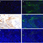 <strong>Figure 7 IF Validation of SARS-CoV2 Spike in COVID-19 Patient Lung </strong><br> (Magro et al., 2020) SARS-CoV2 spike protein (red, panel C) detected detected by anti-spike antibodies (3525, 0.2 μg/mL) colocalized with C4d (green in panel d, merged in yellow). Spike protein (red, panel g) was also colocalized with C5b-9 (green in panel f&h, merged in yellow)