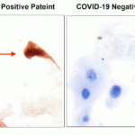 <strong>Figure 9 IHC Validation of SARS-CoV2 Spike in the Nasopharyngeal Swab Sample of the COVID-19 Patient </strong><br> Strong spike signal was detected by anti-spike antibodies (3525, 0.2 μg/mL) in the nasopharyngeal swab sample of the COVID-19 patient and no spike signal was observed in the sample of the COVID-19 negative patient. COVID-19 cases were confirmed by PCR. (Courtesy of Dr. Nuovo Gerard J., OSU)