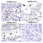 <strong>Figure 4 Immunohistochemistry Validation of SARS-CoV-2 (COVID-19) Spike S1 in COVID-19 Patient Lung</strong><br> Immunohistochemical analysis of paraffin-embedded COVID-19 patient lung tissue using anti- SARS-CoV-2 (COVID-19) Spike S1 antibody (9083, 0.5 μg/mL). Tissue was fixed with formaldehyde and blocked with 10% serum for 1 h at RT; antigen retrieval was by heat mediation with a citrate buffer (pH6). Samples were incubated with primary antibody overnight at 4 °C. A goat anti-rabbit IgG H&L (HRP) at 1/250 was used as secondary. Counter stained with Hematoxylin. Strong signal of SARS-COV-2 spike protein was observed in macrophage of COVID-19 patient lung, but not in non-COVID-19 patient lung.