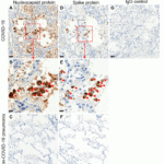 <strong>Figure 3 Immunohistochemistry Validation of SARS-CoV-2 (COVID-19) Spike S1 in Human Lung Tissue from the COVID-19 Patient (Sun et al., 2020)</strong><br> Detection of SARS-CoV-2 nucleocapsid protein by anti-SARS-COV-2 nucleocapsid antibodies (9099, 0.02 μg/mL, A,B) or SARS-CoV-2 Spike S1 antibodies (9083, 1 μg/mL D,E) in adjacent sections of autopsy lung tissue from COVID-19 deceased patient. Negative control staining on autopsy lung tissue from patient who died from non-COVID-19 pneumonia is shown for Nucleocapsid protein (C) or Spike protein (F). Negative control using normal rabbit immunoglobulin on COVID-19 autopsy tissue is presented (G). DAB chromogen and hematoxylin counterstain are used. Scale bars: 50μM in A, C, D, F, G; 20μM in B and E.