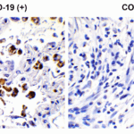 <strong>Figure 1 Immunohistochemistry Validation of SARS-CoV-2 (COVID-19) Spike S2 in COVID-19 Patient Lung</strong><br> Immunohistochemical analysis of paraffin-embedded COVID-19 patient lung tissue using anti- SARS-CoV-2 (COVID-19) Spike S2 antibody (9123, 0.1 μg/mL). Tissue was fixed with formaldehyde and blocked with 10% serum for 1 h at RT; antigen retrieval was by heat mediation with a citrate buffer (pH6). Samples were incubated with primary antibody overnight at 4°C. A goat anti-rabbit IgG H&L (HRP) at 1/250 was used as secondary. Counter stained with Hematoxylin. Strong signal of SARS-COV-2 spike protein was observed in macrophage of COVID-19 patient lung, but not in non-COVID-19 patient lung.