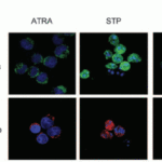 <strong>Figure 8 Immunofluorescence Analysis of Smac in NB4-LR1 Cells (Saumet et al., 2005) </strong><br>  NB4-LR1 cells were either treated with ATRA(1 μM) for 3 days without or with the T3C1 recombinant fragment (3 μM) or treated with staurosporine (STP; 5 μM ) for 3.5 hours. STP, but not ATRA or AYRA/T3C1 induced the release of smac.