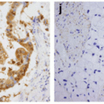 <strong>Figure 7 Immunohistochemistry Validation of Smac in Human gastric carcinoma (Kim et al., 2011) </strong><br> Smac was highly expressed in gastric mucosa of patients with gastric carcinoma.
