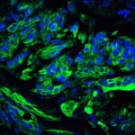 Immunofluorescence of TET2 in human colon carcinoma tissue with TET2 antibody at 20 μg/ml.<br><br>Green: TET2 Antibody (6915) <br> Blue: DAPI staining