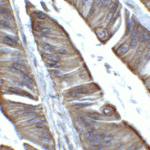 Immunohistochemistry of TET2 in human colon carcinoma tissue with TET2 antibody at 2 μg/ml.