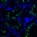 Immunofluorescence of TIGIT in human stomach carcinoma tissue using TIGIT Antibody at 5 μg/ml.<br><br>Green: TIGIT Antibody [10B1] (RF16058) <br> Blue: DAPI staining