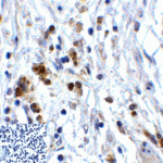 Immunohistochemistry of TIGIT in human stomach carcinoma tissue using TIGIT Antibody and control mouse IgG (corner box) at 2 μg/ml.