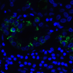 Immunofluorescence of TIGIT in human stomach carcinoma tissue using TIGIT Antibody at 5 μg/ml.<br><br>Green: TIGIT Antibody [3B5] (RF16053) <br> Blue: DAPI staining