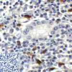 Immunohistochemistry of TIGIT in human stomach carcinoma tissue using TIGIT Antibody and control mouse IgG (corner box) at 2 μg/ml.