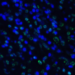 Immunofluorescence of TIGIT in human stomach carcinoma tissue using TIGIT Antibody at 5 μg/ml.<br><br>Green: TIGIT Antibody [4A10] (RF16054) <br> Blue: DAPI staining