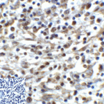 Immunohistochemistry of TIGIT in human stomach carcinoma tissue using TIGIT Antibody and control mouse IgG (corner box) at 2 μg/ml.
