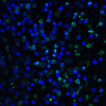 Immunofluorescence of TIGIT in human stomach carcinoma tissue using TIGIT Antibody at 5 μg/ml.<br><br>Green: TIGIT Antibody [4A11] (RF16055) <br> Blue: DAPI staining