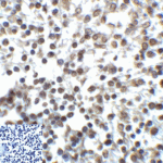 Immunohistochemistry of TIGIT in human stomach carcinoma tissue using TIGIT Antibody and control mouse IgG (corner box) at 2 μg/ml.