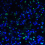Immunofluorescence of TIGIT in human stomach carcinoma tissue using TIGIT Antibody at 5 μg/ml.<br><br>Green: TIGIT Antibody [4A12] (RF16056) <br> Blue: DAPI staining
