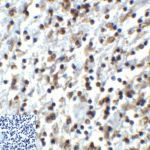 Immunohistochemistry of TIGIT in human stomach carcinoma tissue using TIGIT Antibody and control mouse IgG (corner box) at 2 μg/ml.